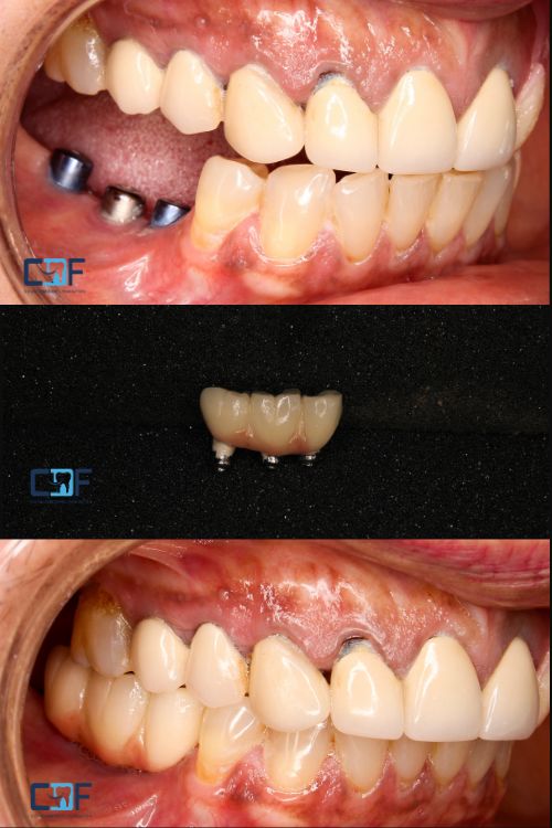 Multiple Implants Before and After